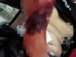 Ngeri, Lengan Pemuda ini Nyaris Putus Akibat Aksi Tawuran di Ciomas