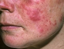 Kenali Gejala Lupus “Penyakit Seribu Wajah”