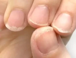 Inilah 5 Warna Kuku Bisa Jadi Tanda Gangguan Kesehatan