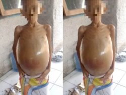 Idap Kanker Perut, M Sakti Warga Pamijahan Butuh Uluran Tangan untuk Berobat