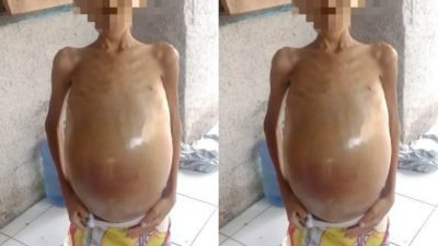 Idap Kanker Perut, M Sakti Warga Pamijahan Butuh Uluran Tangan untuk Berobat