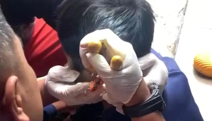 Dramatis, Damkar Keluarkan Kail Pancing yang Nyangkut ke Telinga Bocah di Cibinong